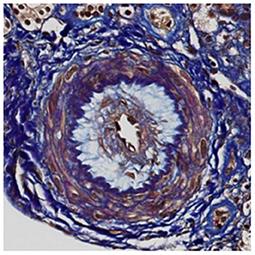 Case Report: A Rare Truncating Variant of the CFHR5 Gene in IgA Nephropathy